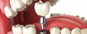 dental implant surgery