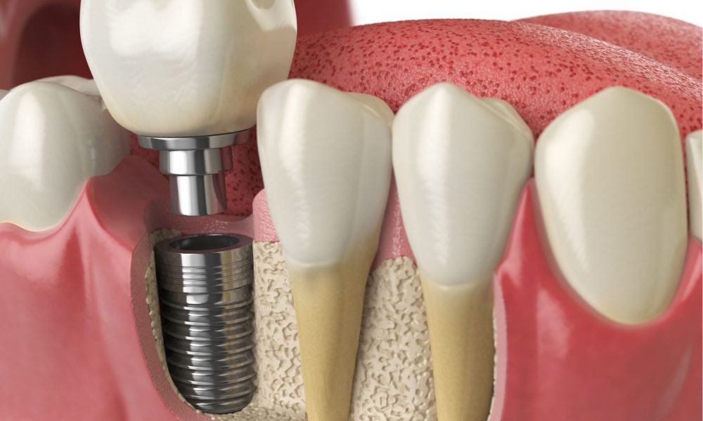 Dental Implants Near Me Cost