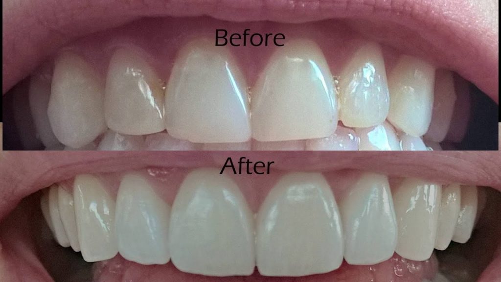 dental veneers