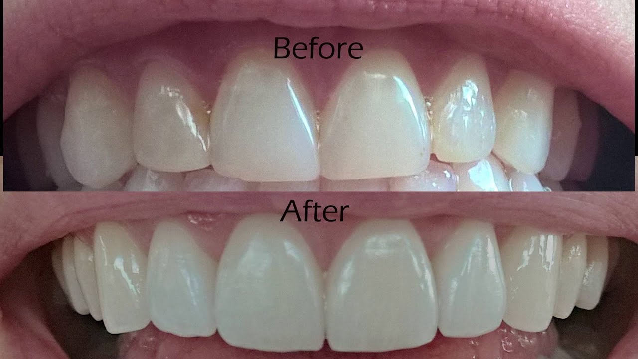 veneers dental perfect near teeth veneer cost smile procedure before dentist smiles born help range everyone